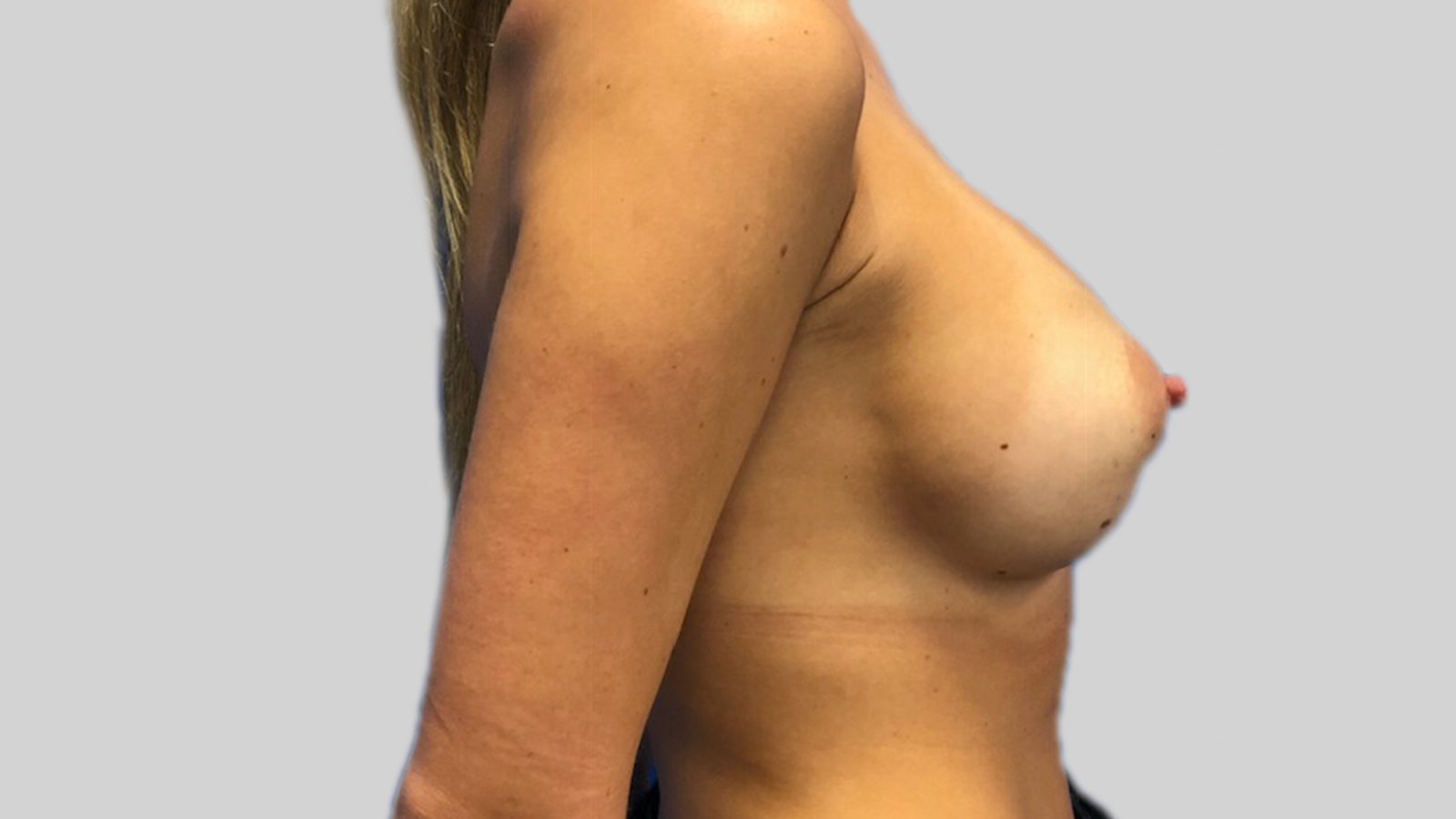 Breast-Augmentation-after-1
