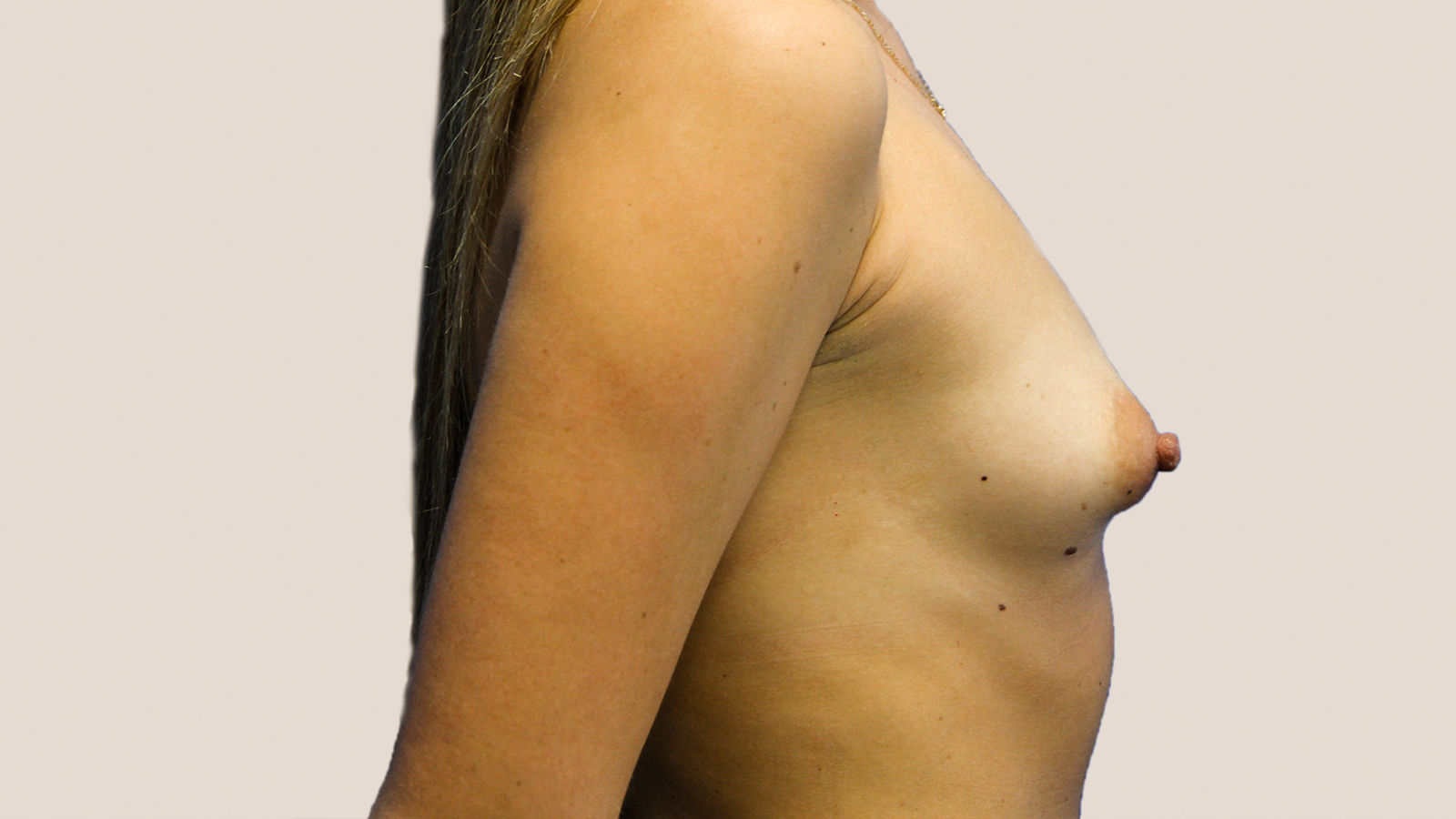 Breast-Augmentation-before-1