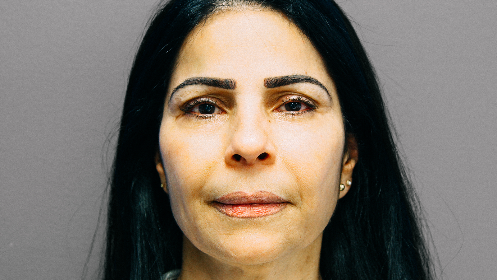 Fillers-after-2