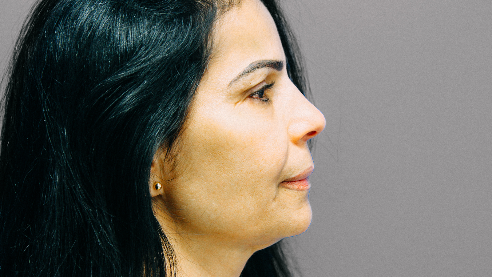 Fillers-after