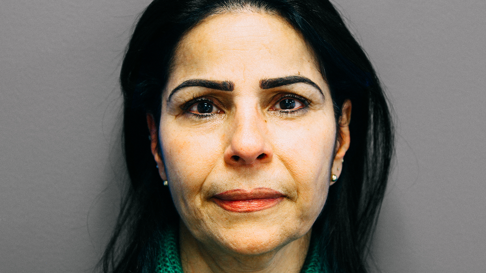 Fillers-before-2