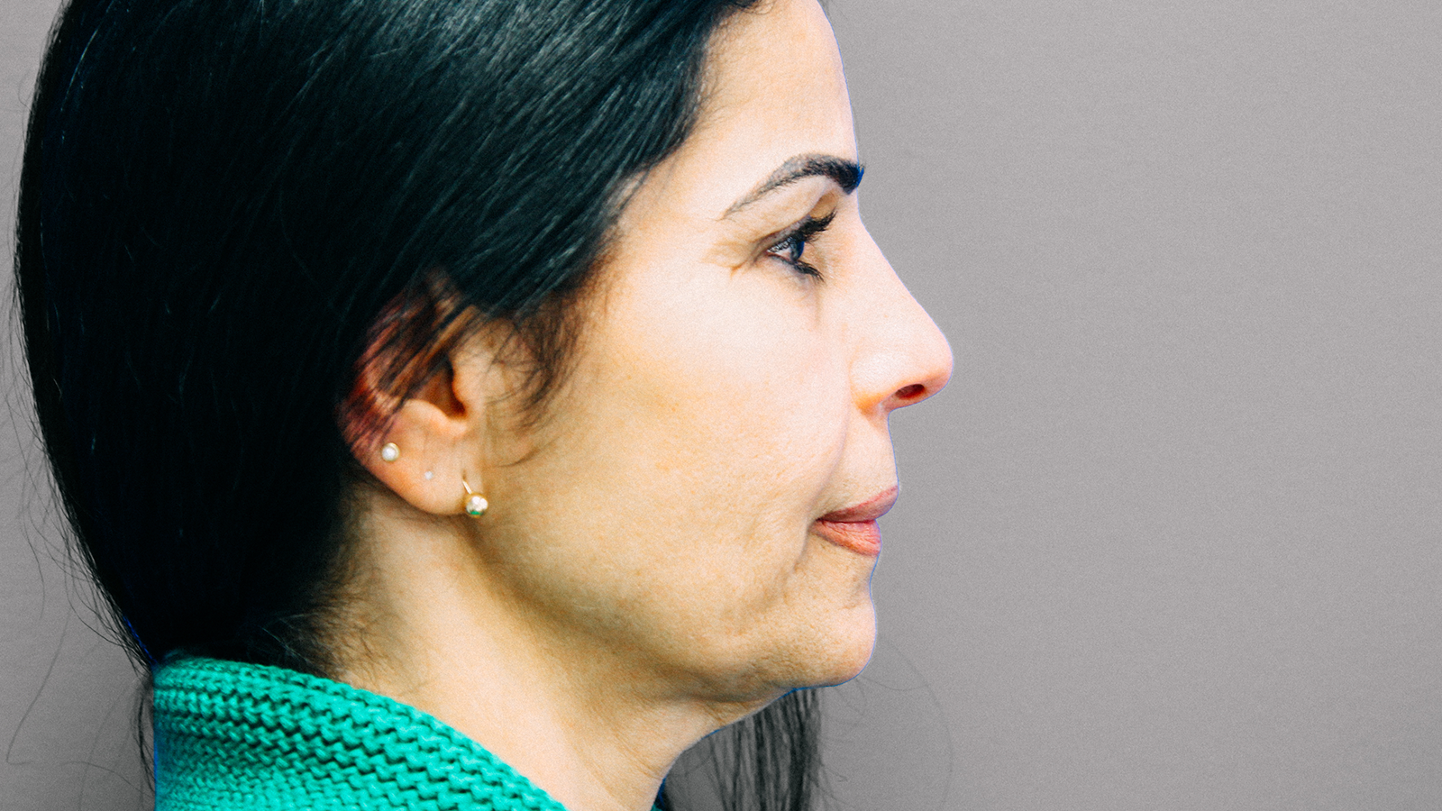 Fillers-before