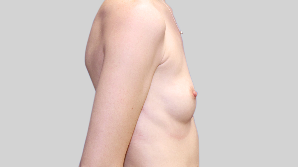 clinique-dr-karl-schwarz-montreal-Breast-Augmentation2-beforer