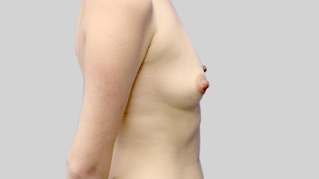 clinique-dr-karl-schwarz-montreal-Breast-Augmentation3-before