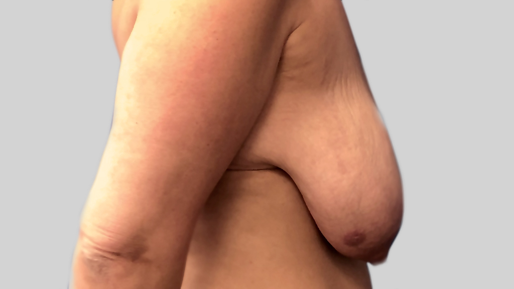 clinique-dr-karl-schwarz-montreal-Breast-Lift2-before