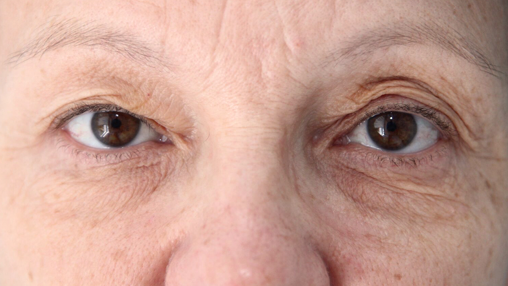 clinique-dr-karl-schwarz-montreal-Eyelid-Surgery-1-before