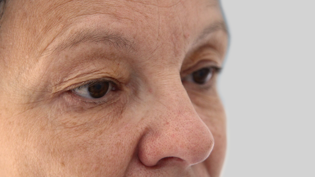 clinique-dr-karl-schwarz-montreal-Eyelid-Surgery-2-before