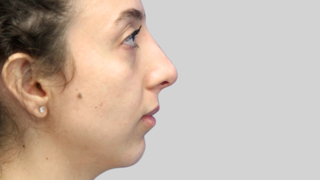 clinique-dr-karl-schwarz-montreal-NON-SURGICAL-NOSE-JOB2-after