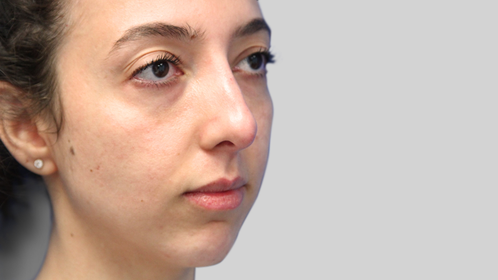 clinique-dr-karl-schwarz-montreal-NON-SURGICAL-NOSE-JOB3-after