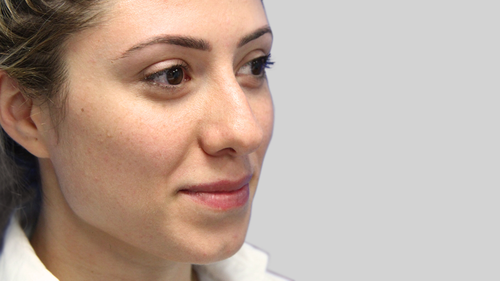 clinique-dr-karl-schwarz-montreal-NON-SURGICAL-NOSE-JOB4-before