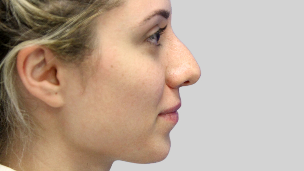 clinique-dr-karl-schwarz-montreal-NON-SURGICAL-NOSE-JOB5-before