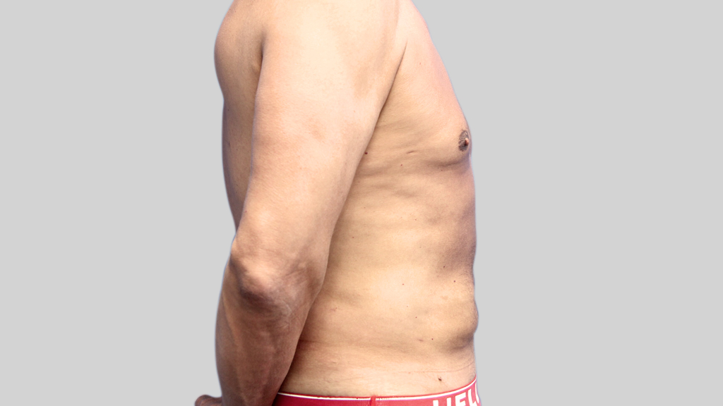 montreal-Tummy-Tuck-men