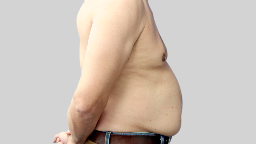 montreal-Tummy-Tuck-men