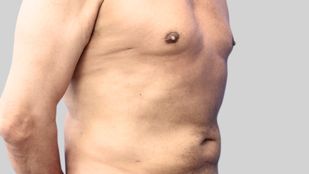 montreal-Tummy-Tuck-men after