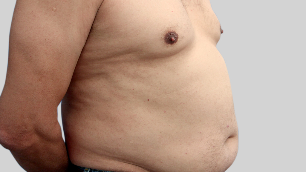montreal-Tummy-Tuck-men