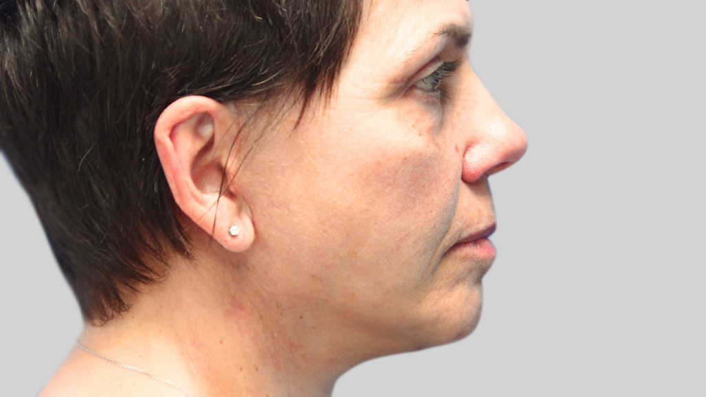 clinique-dr-karl-schwarz-montreal-face-lift-3-after