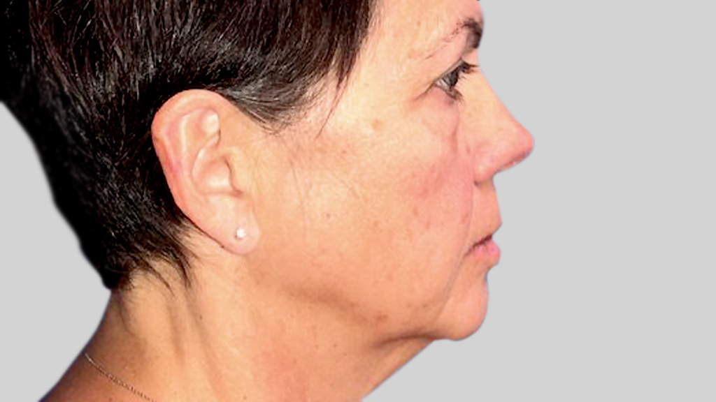 clinique-dr-karl-schwarz-montreal-face-lift-3-before