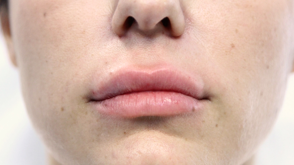 clinique-dr-karl-schwarz-montreal-lip-augmentation-after