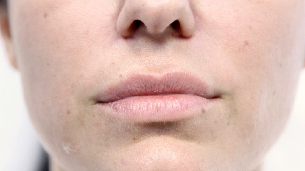 clinique-dr-karl-schwarz-montreal-lip-augmentation-before
