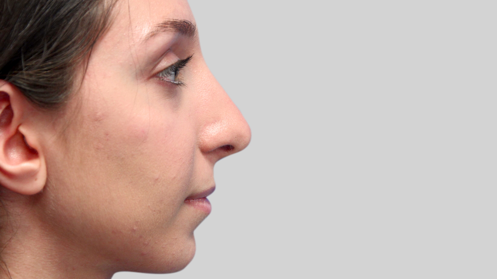 clinique-dr-karl-schwarz-montreal-nose-job1-after