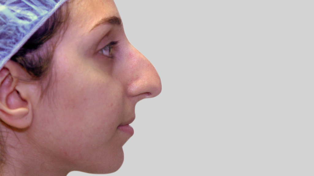 clinique-dr-karl-schwarz-montreal-nose-job1-before