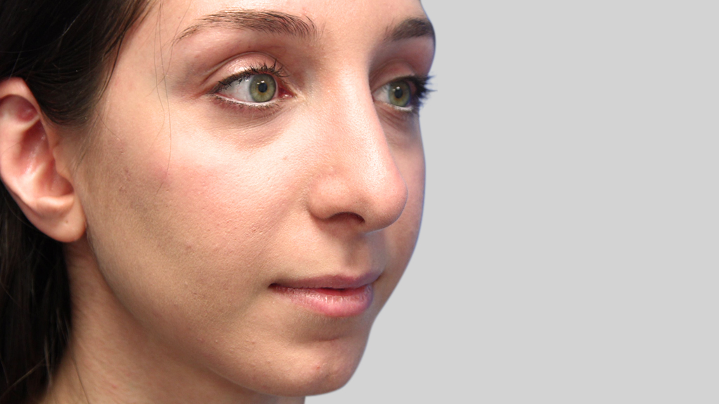 clinique-dr-karl-schwarz-montreal-nose-job2-after