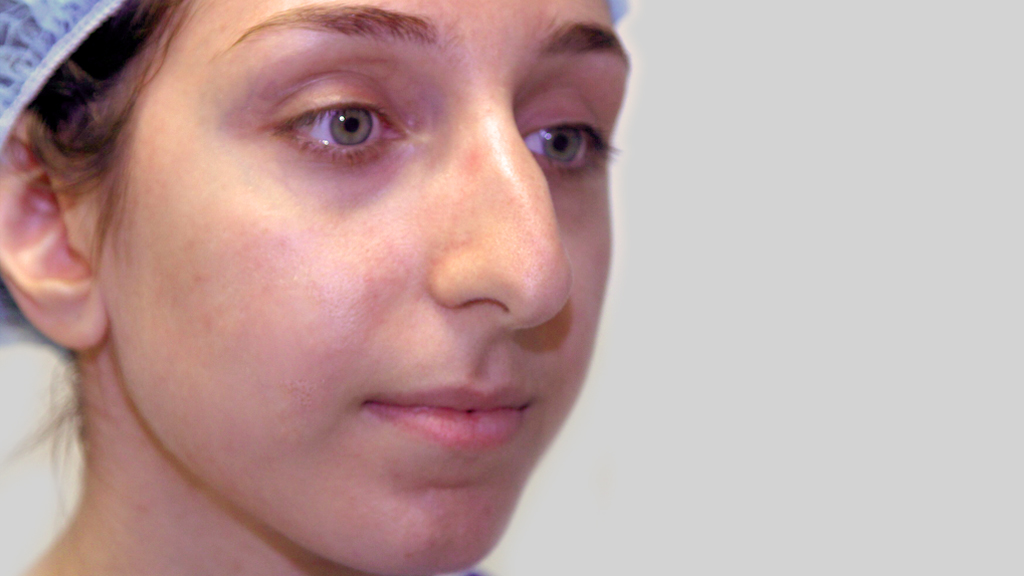 clinique-dr-karl-schwarz-montreal-nose-job2-before
