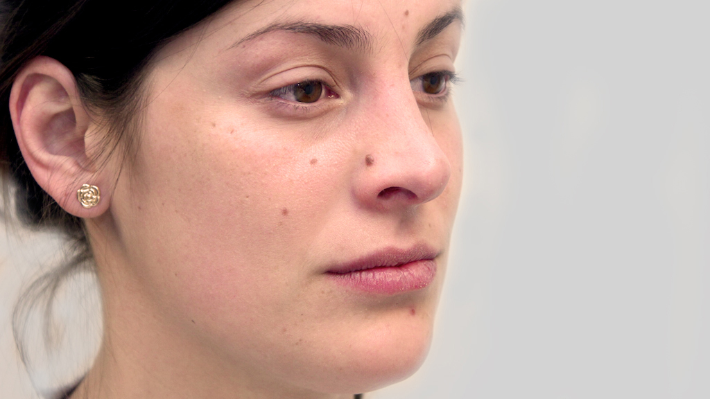 after nose job