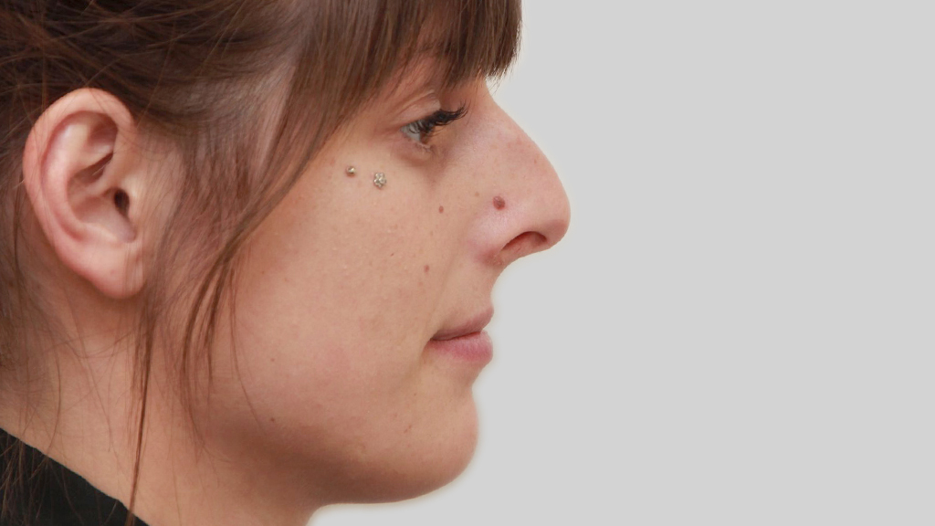montreal nose job female
