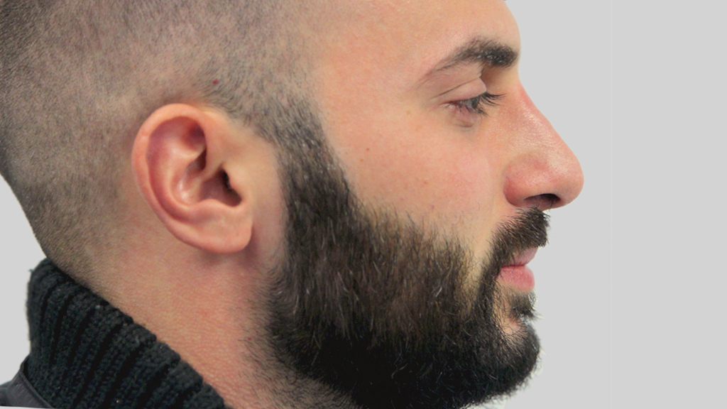 clinique dr karl schwarz montreal nose job after