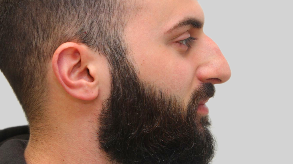 clinique dr karl schwarz montreal nose job before