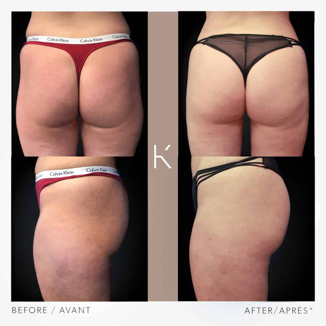 Who Is a Good Candidate for a Brazilian Butt Lift? - Folsom Ca