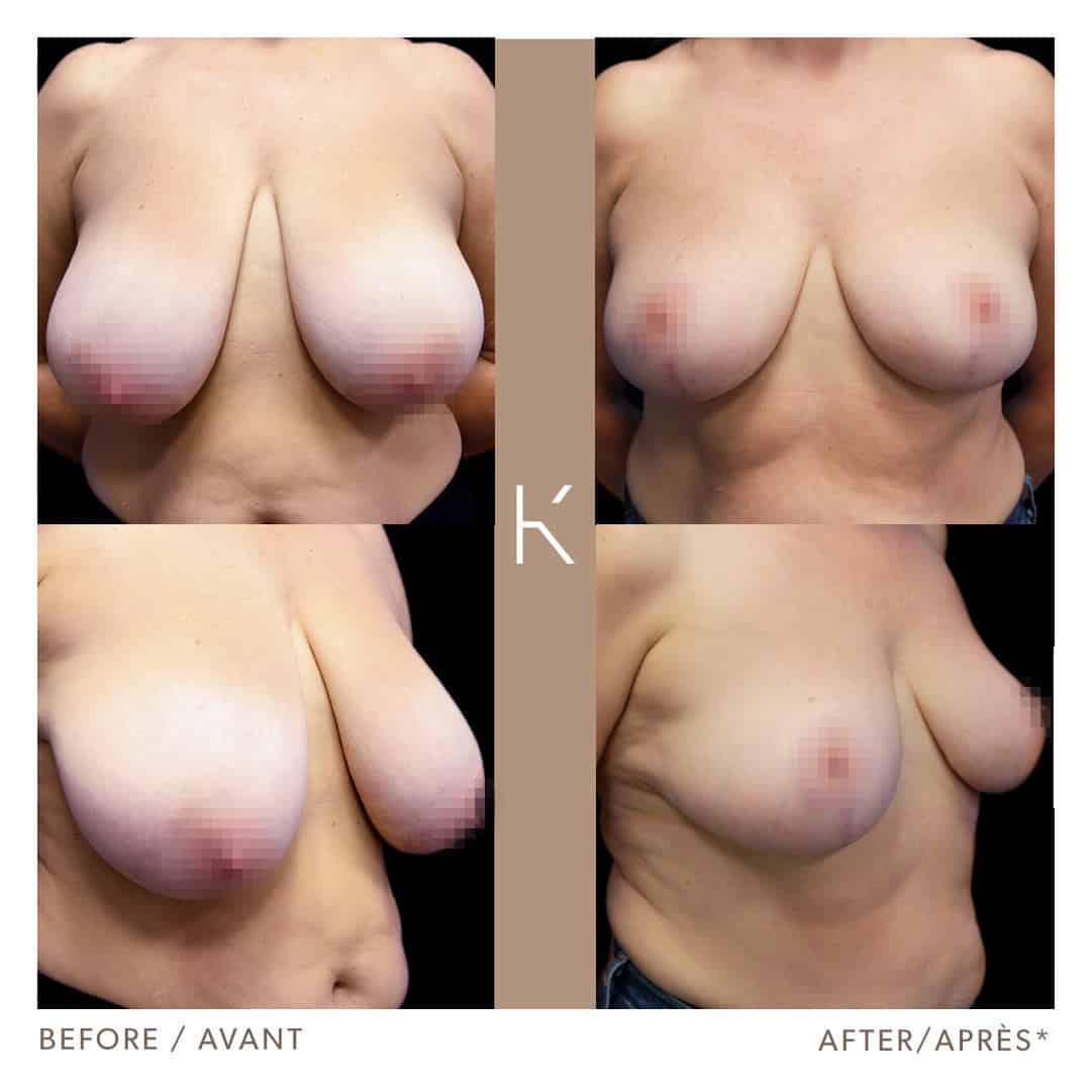 Réduction mammaires avant-après
