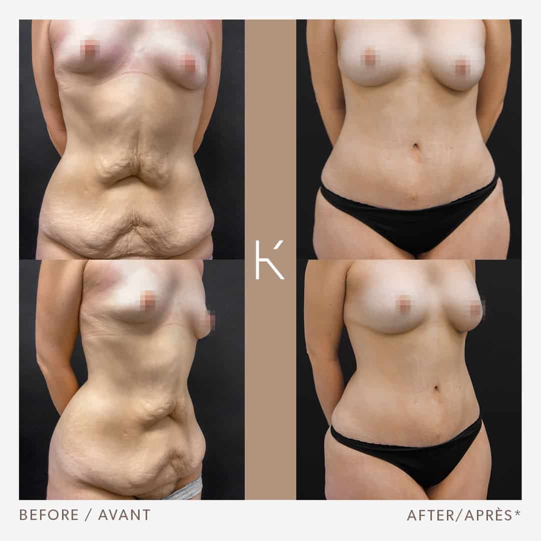 Patient 1482 Tummy Tuck, Breast Reduction, Mommy Makeover Before