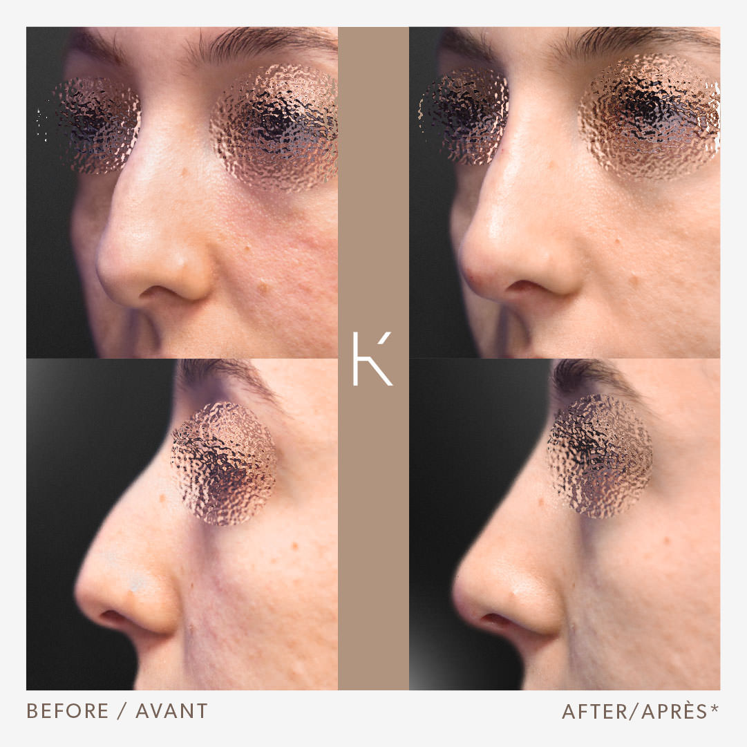 Non-surgical Rhinoplasty and Chin