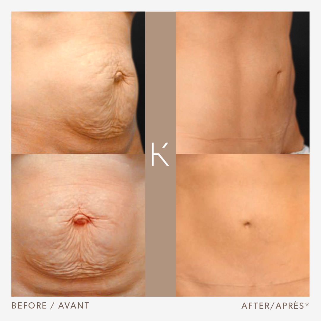 Tummy Tuck  Schwarz Plastic Surgery Clinic in Montreal