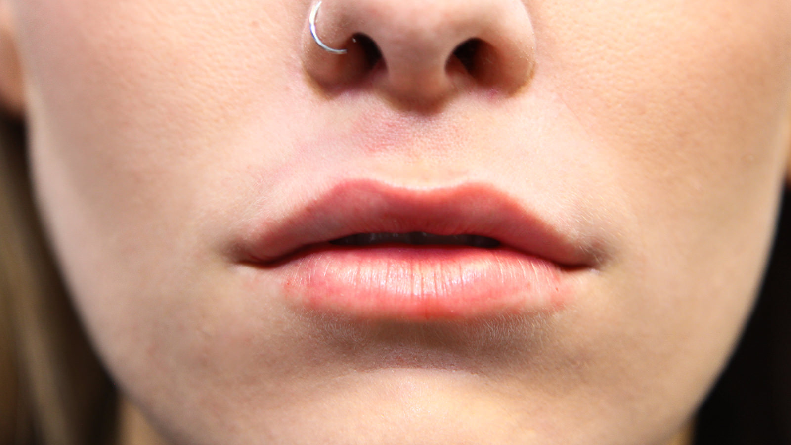 nose job