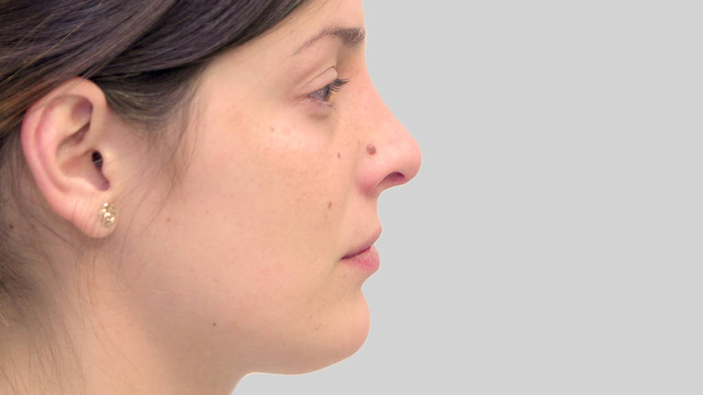 clinique dr karl schwarz montreal nose job