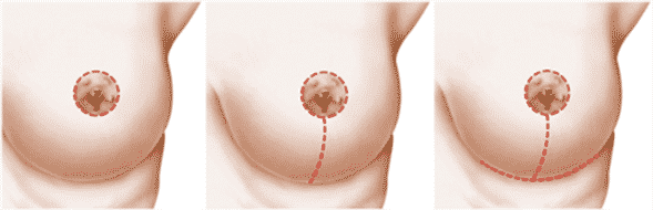 Réduction mammaires, schéma de l'intervention