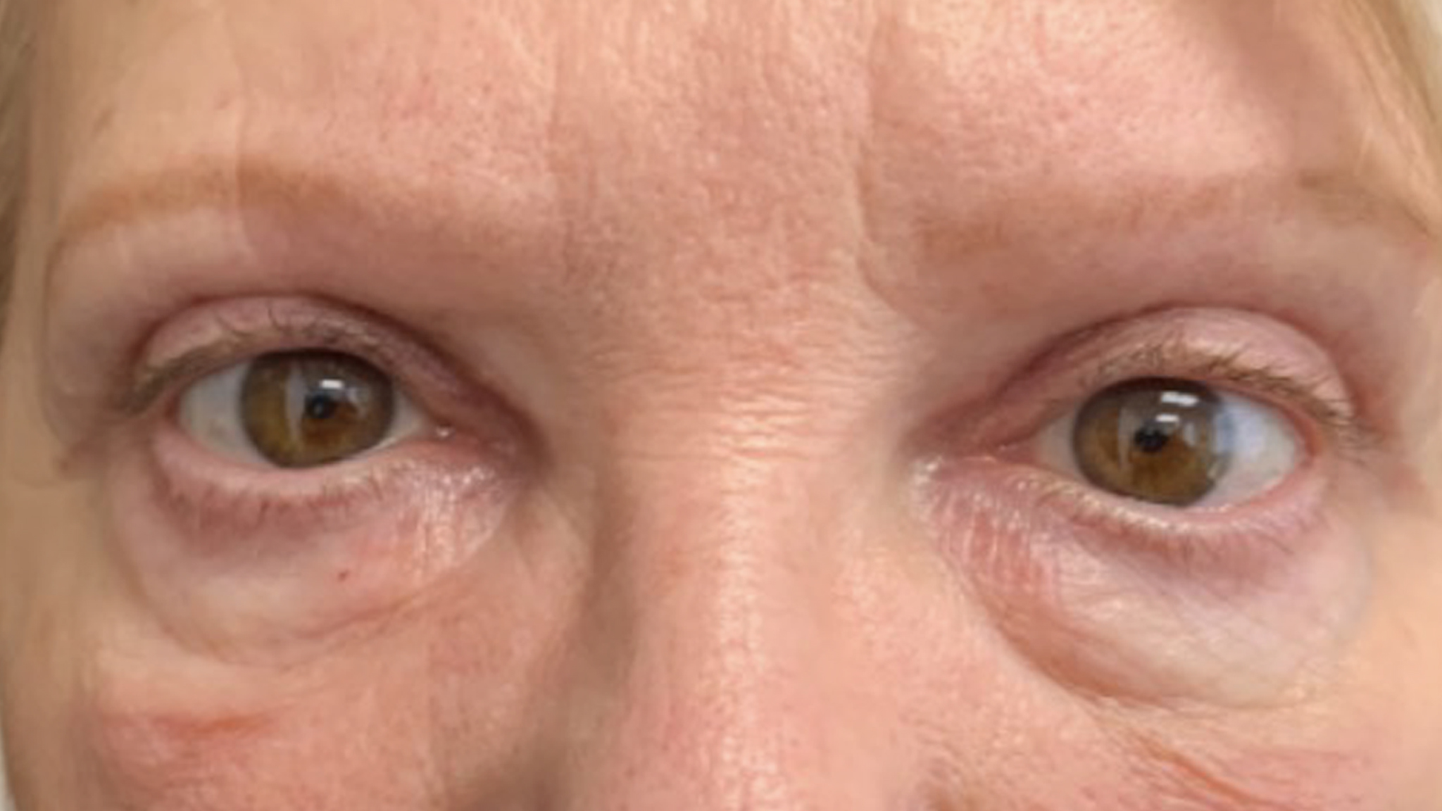 Blepharoplasty_front_apres[55]