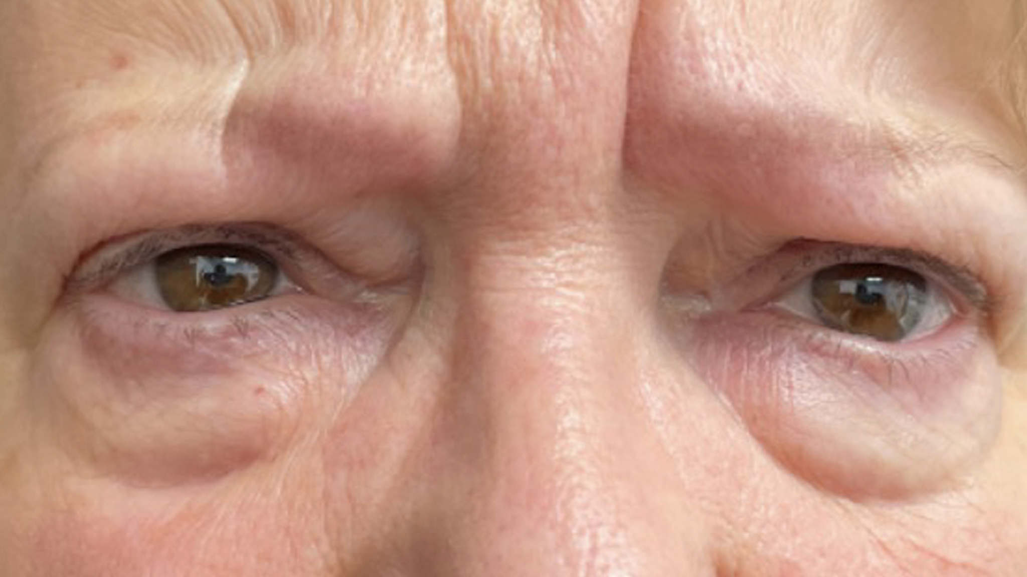 Blepharoplasty_front_avant[74]