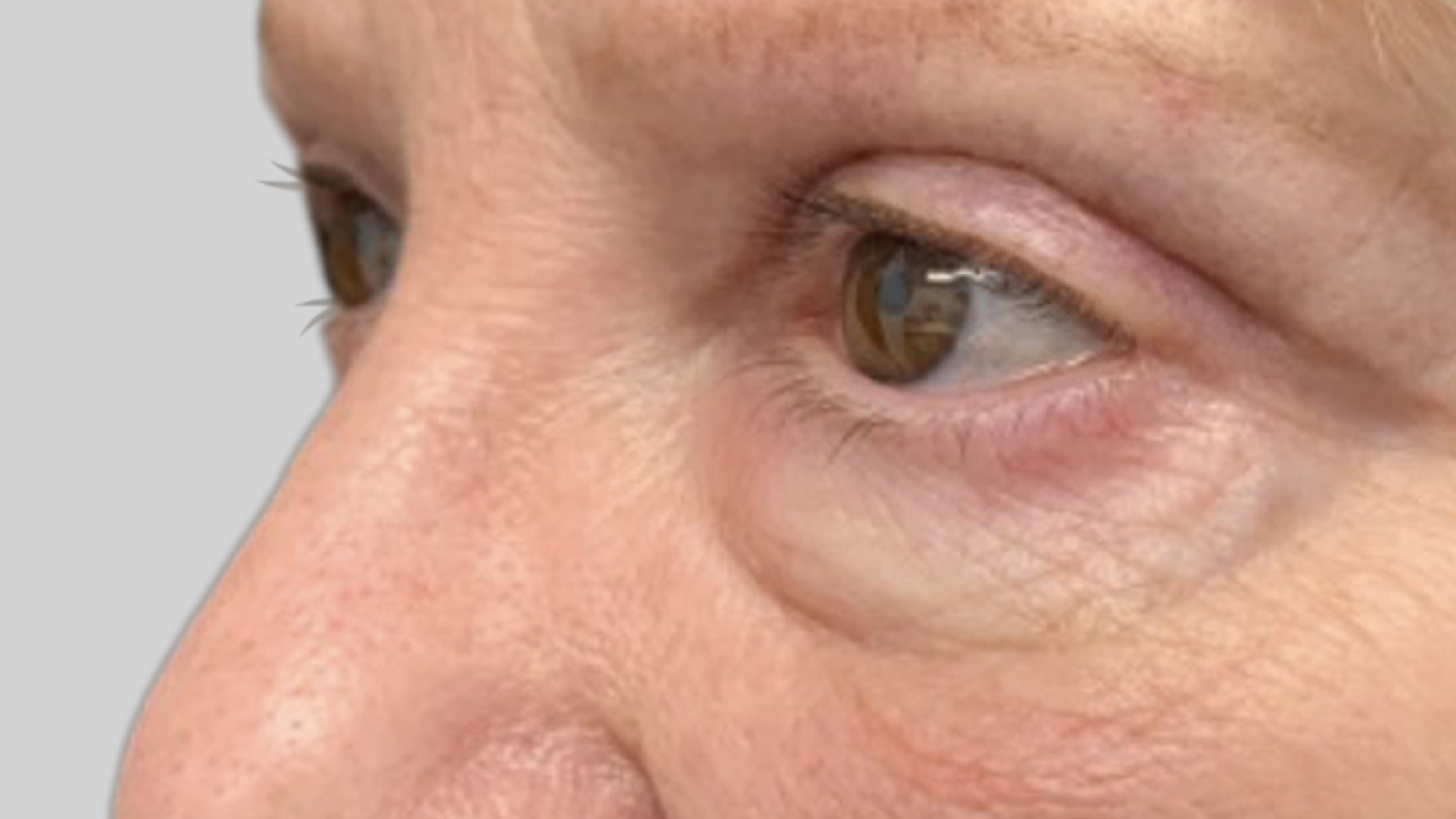 Blepharoplasty_side_angle_apres[52]