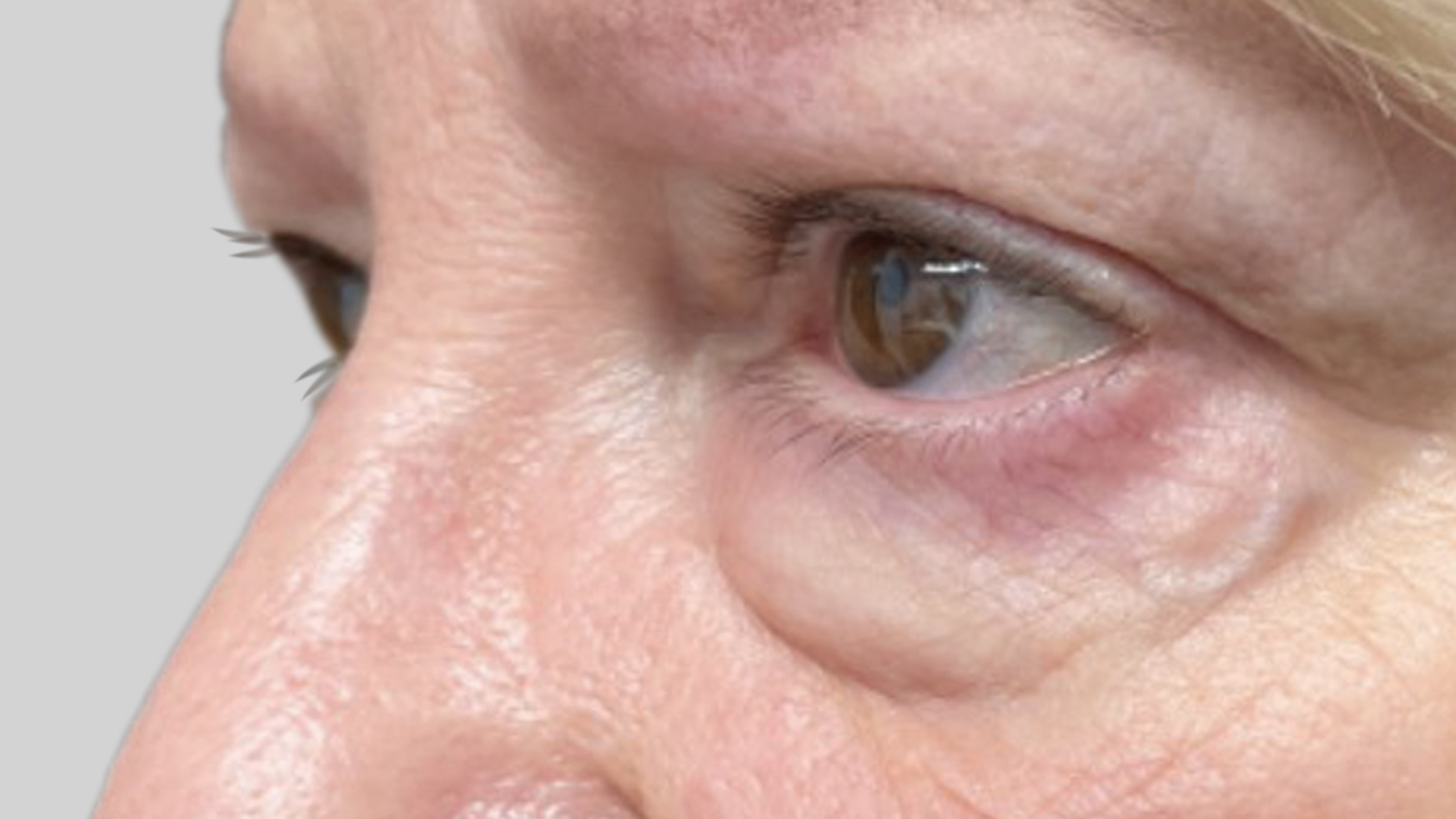 Blepharoplasty_side_angle_avant[76]