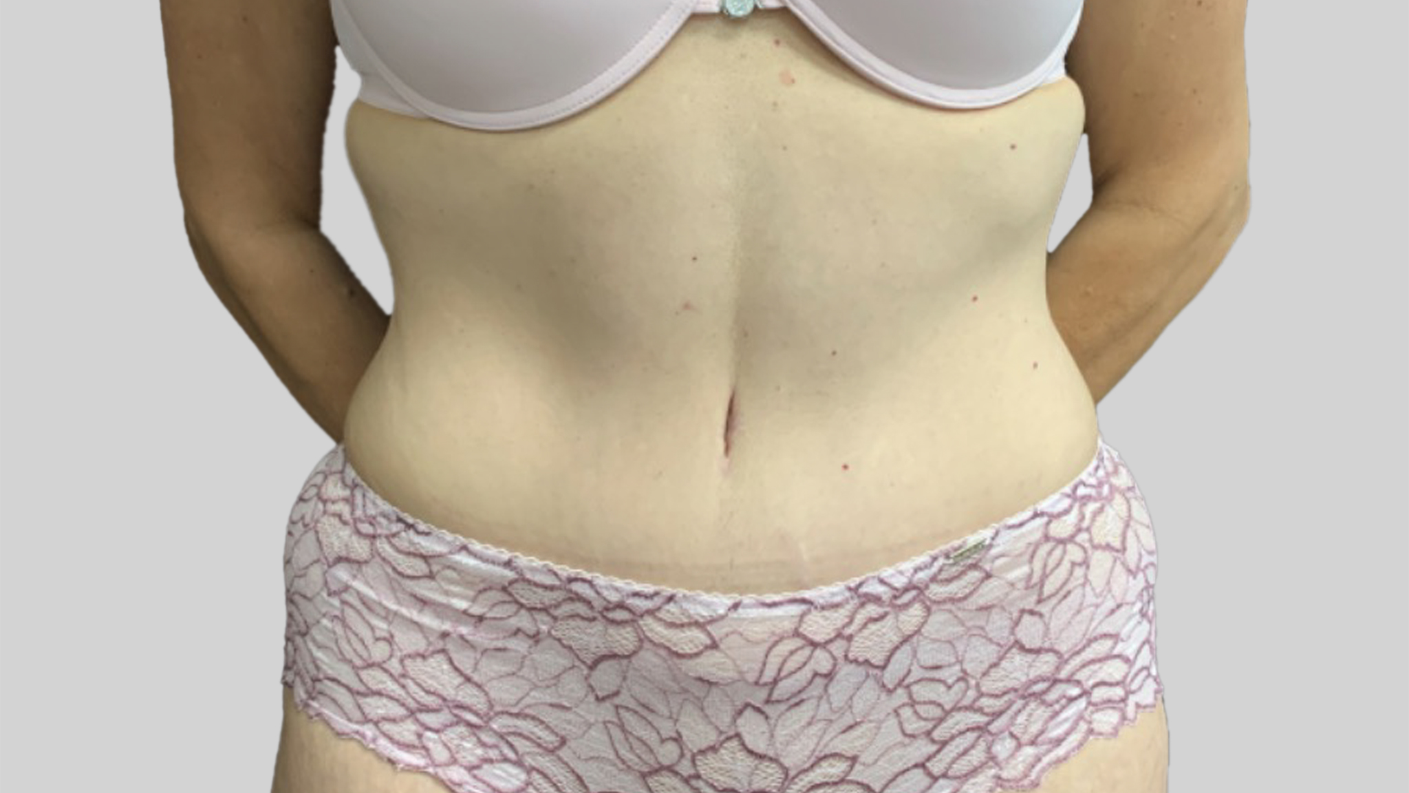 Tummy_tuck_front_apres