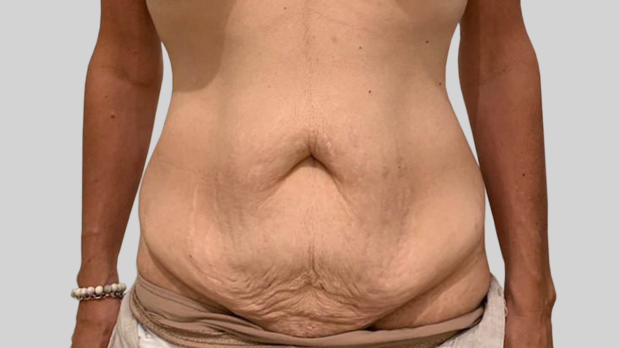 Tummy_tuck_front_avant