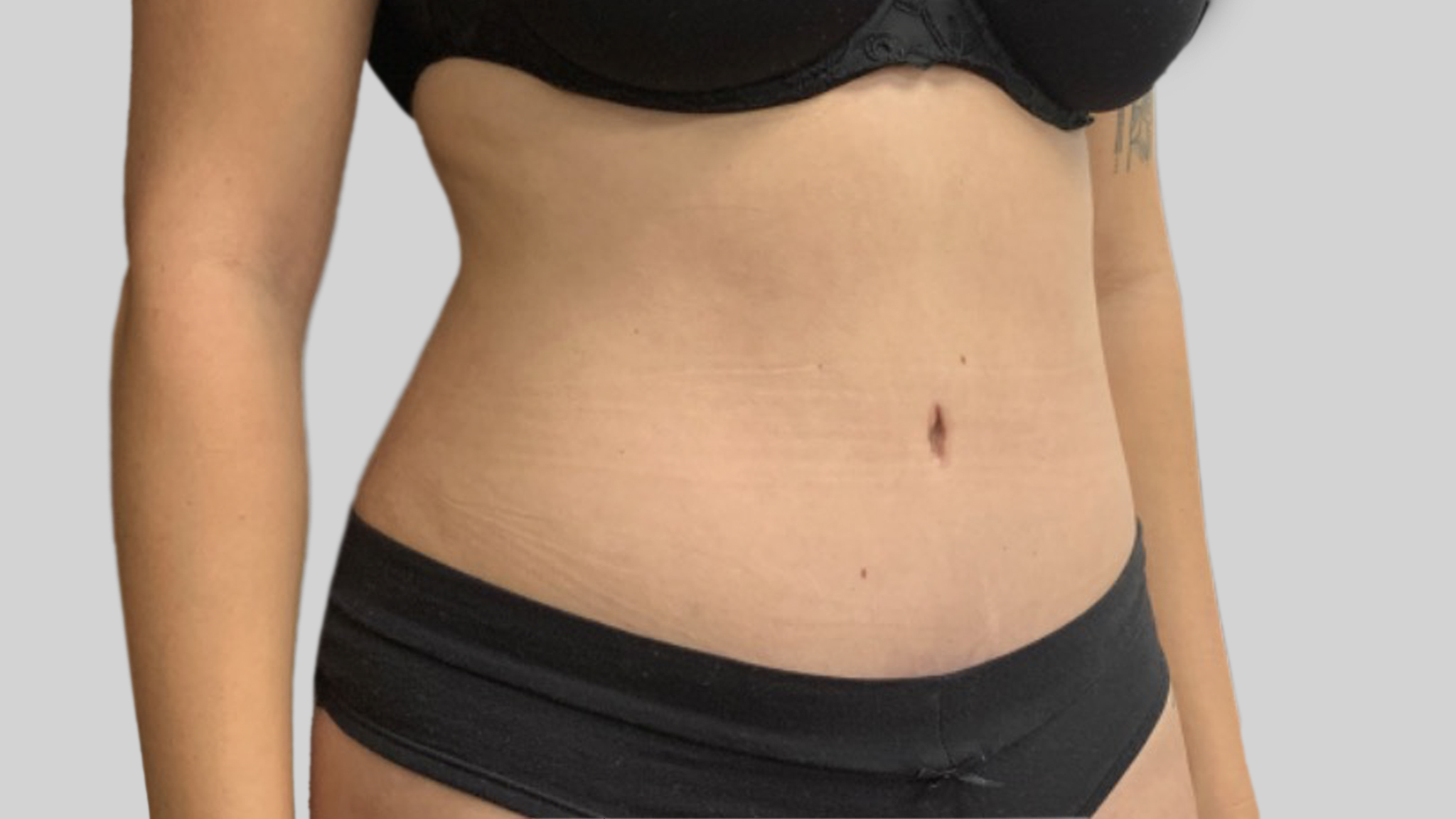 Tummy_tuck_side_angle_apres