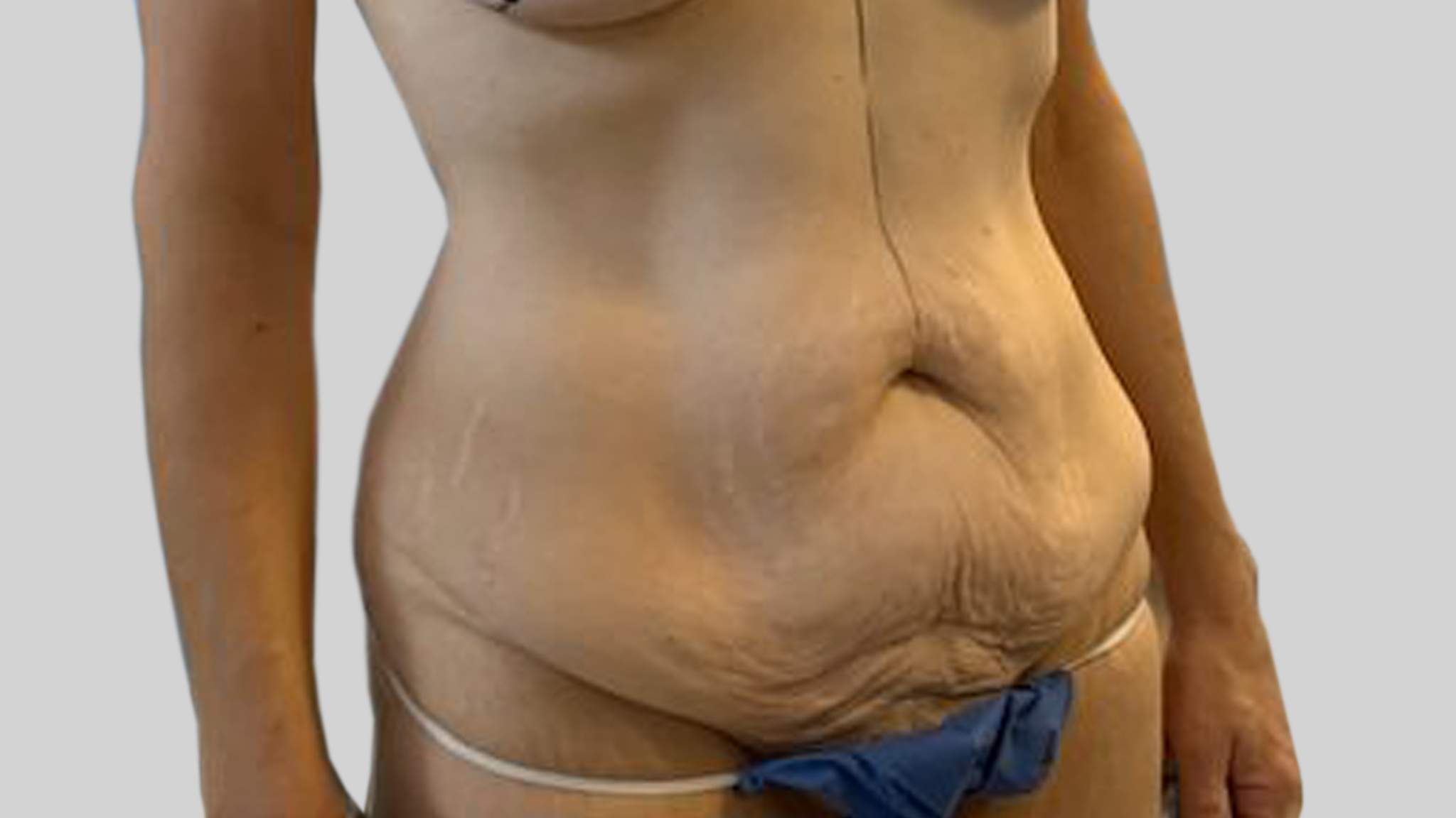 Tummy_tuck_side_angle_avant