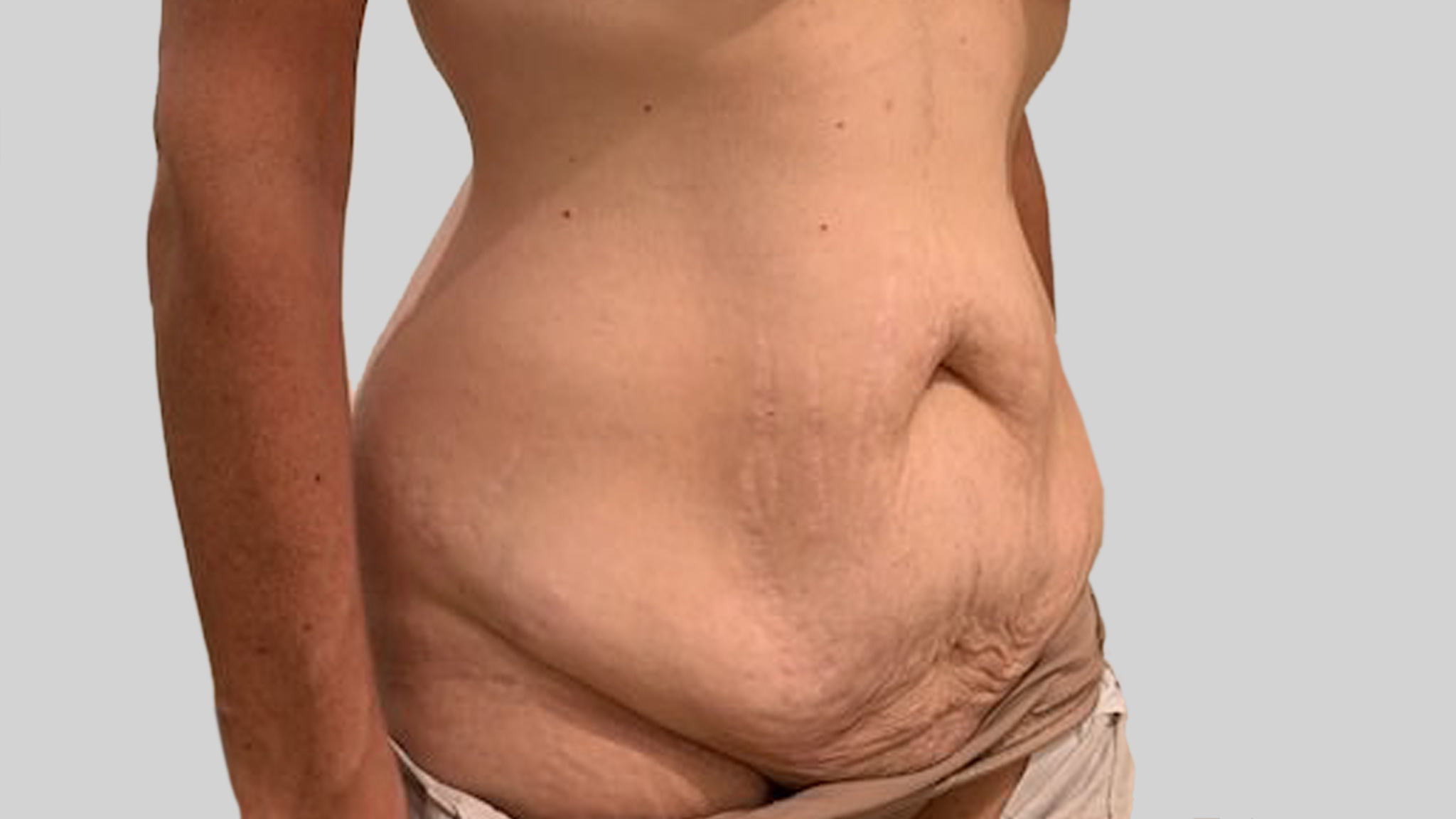 Tummy_tuck_side_angle_avant