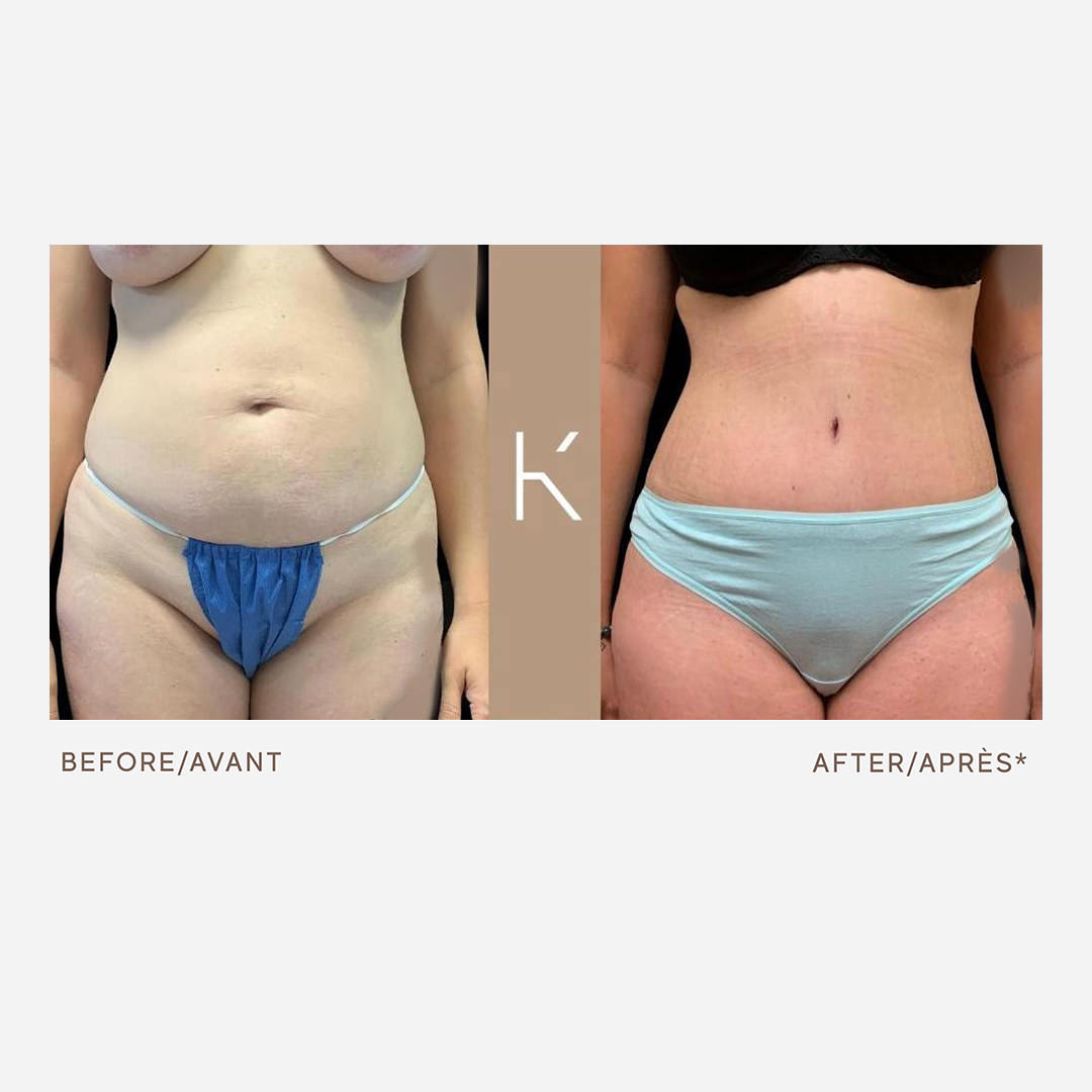 Tummy Tuck  Schwarz Plastic Surgery Clinic in Montreal