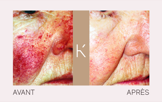 Candela-Medical-VBeam